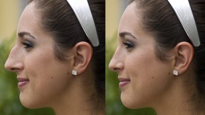 How to get the younger look by choosing the Fat Transfer to face surgery in Ludhiana?