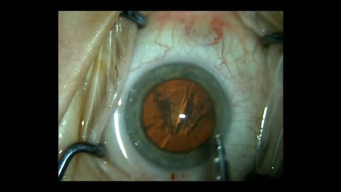 Cataract in Children