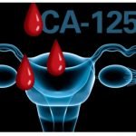 Ovarian Cancer Detection