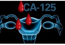 CA125 Test For Ovarian Cancer Detection Ovarian Cancer Detection
