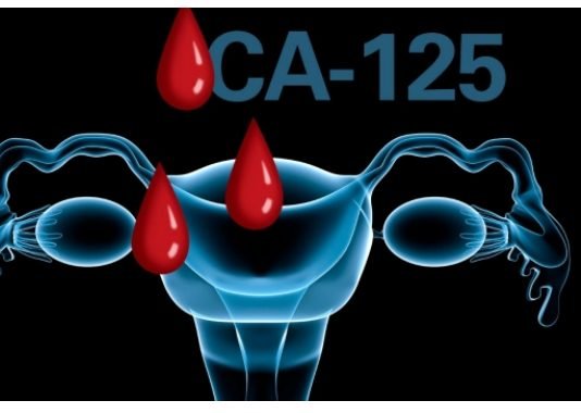CA125 Test For Ovarian Cancer Detection Ovarian Cancer Detection