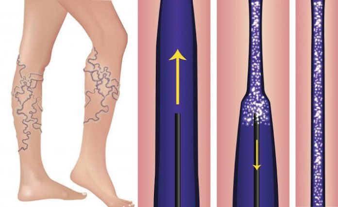Sclerotherapy for varicose and spider veins: Know the procedure here!