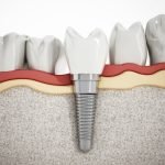 How to Choose a Restorative Dentist: Everything You Need to Know