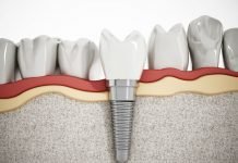 How to Choose a Restorative Dentist: Everything You Need to Know How to Choose a Restorative Dentist: Everything You Need to Know