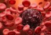 Can blood cancer be treated?