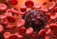 Can blood cancer be treated? Can blood cancer be treated?