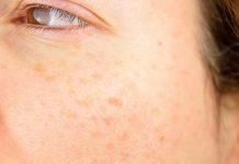 How To Limit Sun Damage This Summer How To Limit Sun Damage This Summer