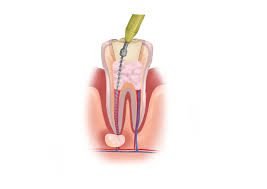 4 Stages of Root Canal Treatment