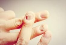 5 Ways to Cure Finger Nail Fungus Finger Nail Fungus