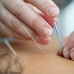 Dry Needling Vs. Acupuncture: The Difference