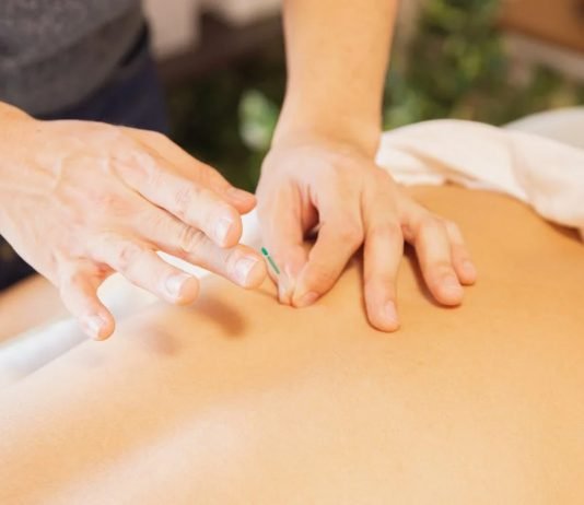 What is Acupuncture Acupuncture