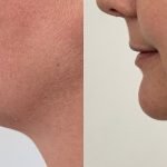 Double Chin Removal