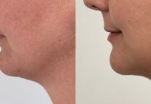Double Chin Removal and Best Activities of Lose Double Chin Double Chin Removal