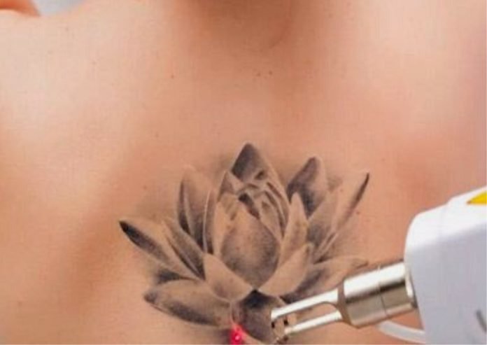 Laser Tattoo Removal