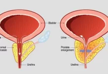 The effective treatment of BPH treatment through relaxing activities. BPH