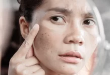 How To Treat Melasma Facial Pigmentation With Tri-Luma Cream Tri-Luma Cream