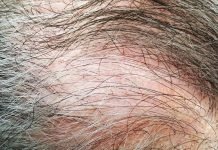 Traction Alopecia in Men: Causes, Symptoms, and Effective Treatment Options Traction Alopecia
