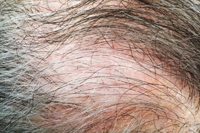 Traction Alopecia