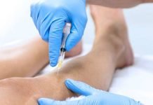 Sclerotherapy: Effective Treatment for Varicose and Spider Veins Sclerotherapy