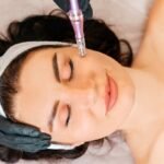 Vivace Microneedle RF