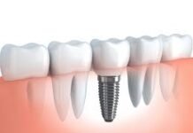 Early Warning Signs: When You Should Check Your Dental Implant Dental Implant