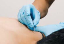 Comparison of Dry Needling and Traditional Acupuncture Techniques Traditional Acupuncture