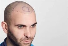 Scalp Micro Pigmentation: Is It the Right Choice for You?