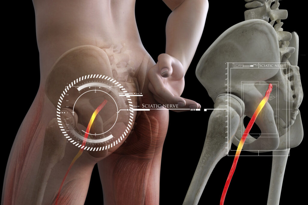 Sciatica 101: Causes, Symptoms, And When To Seek Treatment