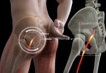 Sciatica 101: Causes, Symptoms, And When To Seek Treatment Symptoms
