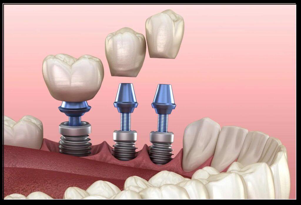 Common Myths About Dental Implants You Shouldn’t Believe 