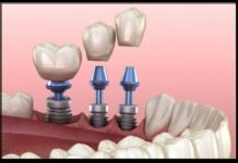 Common Myths About Dental Implants You Shouldn’t Believe Dental Implants