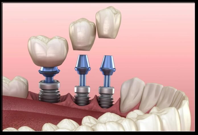 Dental Implants