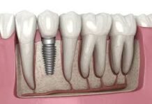 Dental Implants in NYC: Transform Your Smile Today Dental Implants