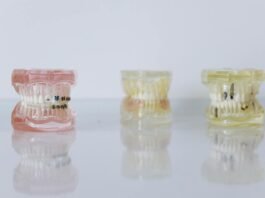 Full Mouth Dental Implants