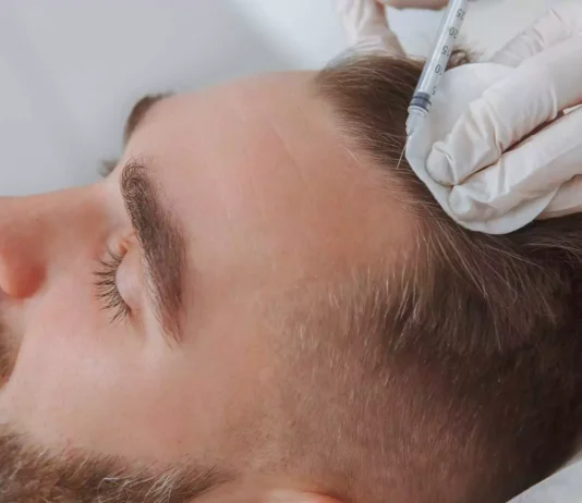 HAIR TRANSPLANT Overview and Definition Hair Transplant